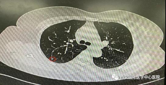 胸科醫院完成西北地區首例“Lung Pro全肺診療導航系統聯合單孔胸腔鏡下右肺上葉后段切除術”
