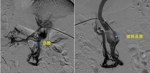 血栓攔路，如何破局——罕見巨大門靜脈血栓TIPS手術實錄