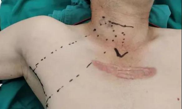 術后傷口可以“隱身”嗎？